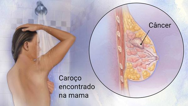 PERFIL CÂNCER DE MAMA